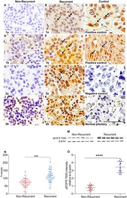 Phosphorylated EGFR (pEGFR T693) as a Novel Predictor of Recurrence in Non-Functioning Pituitary Adenomas